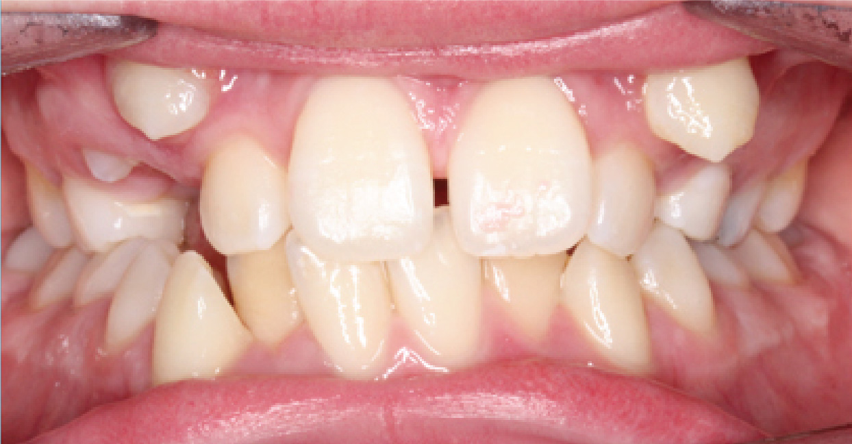 Aligners ba 5
