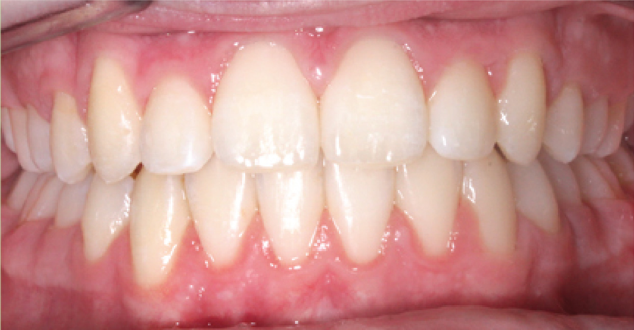 Aligners ba 6