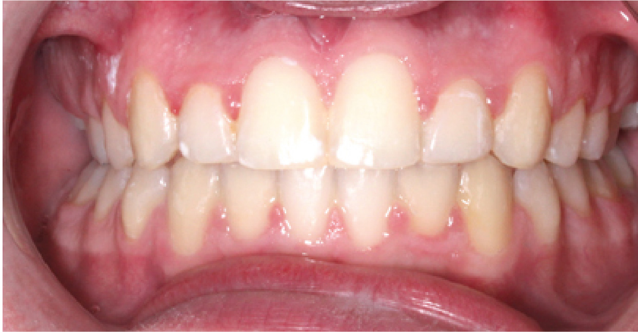 Aligners ba 8